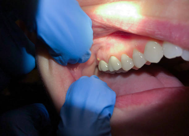 Best Emergency Root Canal Treatment in Galion, OH