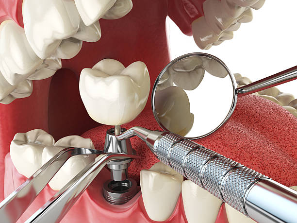 Best Emergency Tooth Extraction in Galion, OH